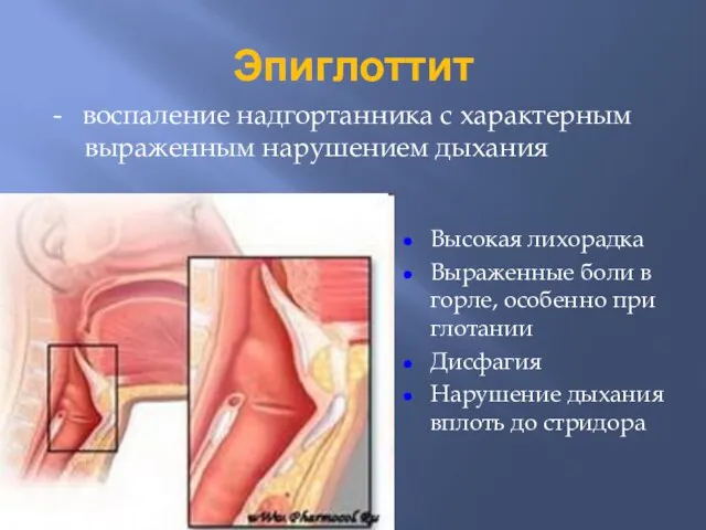 Эпиглоттит - воспаление надгортанника с характерным выраженным нарушением дыхания Высокая лихорадка