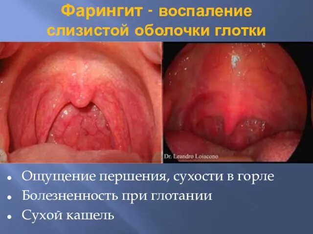 Фарингит - воспаление слизистой оболочки глотки Ощущение першения, сухости в горле Болезненность при глотании Сухой кашель