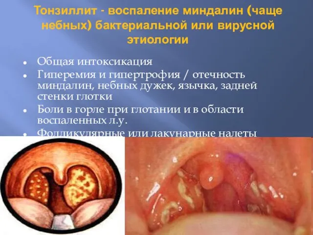 Тонзиллит - воспаление миндалин (чаще небных) бактериальной или вирусной этиологии Общая