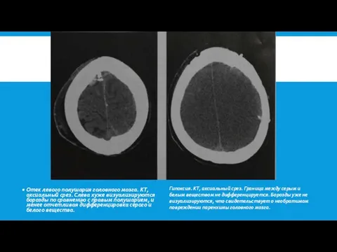 Отек левого полушария голов­ного мозга. КТ, аксиальный срез. Слева хуже визуализируются