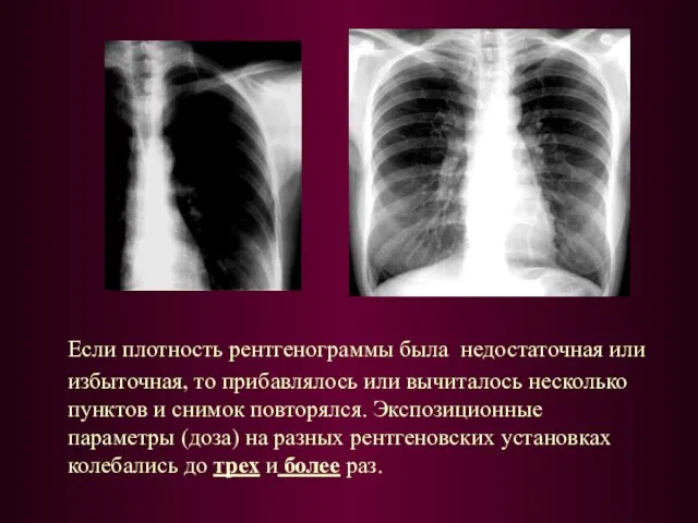 Если плотность рентгенограммы была недостаточная или избыточная, то прибавлялось или вычиталось