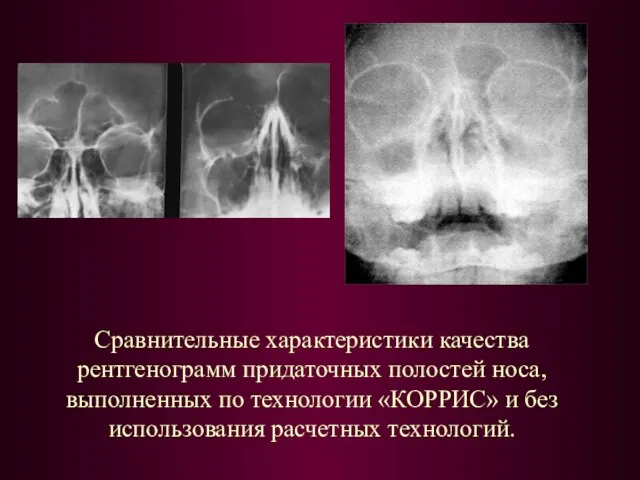 Сравнительные характеристики качества рентгенограмм придаточных полостей носа, выполненных по технологии «КОРРИС» и без использования расчетных технологий.