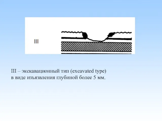 III – экскавационный тип (excavated type) в виде изъязвления глубиной более 5 мм.