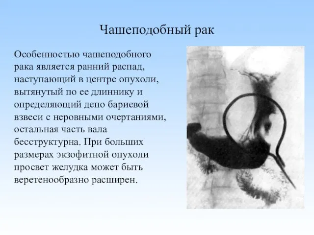 Чашеподобный рак Особенностью чашеподобного рака является ранний распад, наступающий в центре