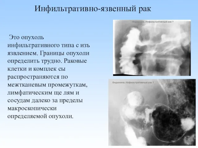 Инфильтративно-язвенный рак Это опухоль инфильтративного типа с изъ язвлением. Границы опухоли