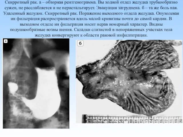 Скиррозный рак. а – обзорная рентгенограмма. Вы ходной отдел желудка трубкообразно