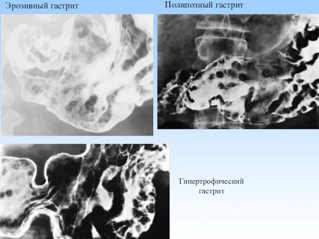 Полипозный гастрит Эрозивный гастрит Гипертрофический гастрит