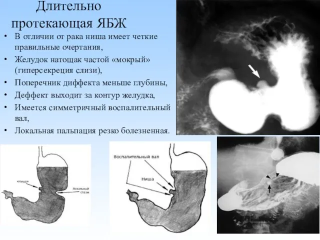 Длительно протекающая ЯБЖ В отличии от рака ниша имеет четкие правильные