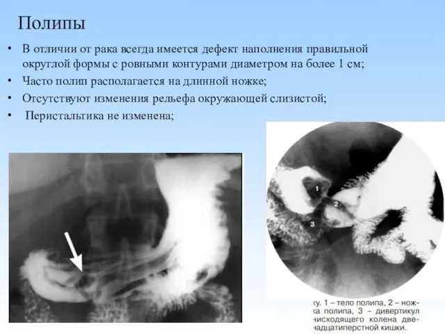 Полипы В отличии от рака всегда имеется дефект наполнения правильной округлой