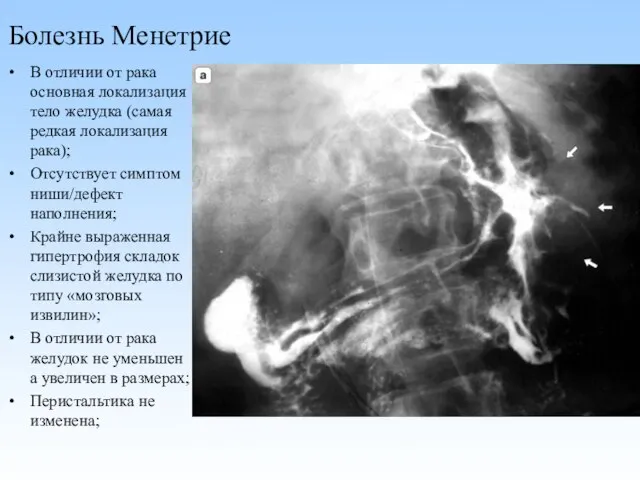 Болезнь Менетрие В отличии от рака основная локализация тело желудка (самая