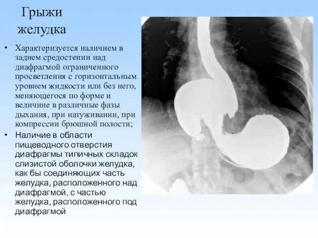 Грыжи желудка Характеризуется наличием в заднем средостении над диафрагмой ограниченного просветления