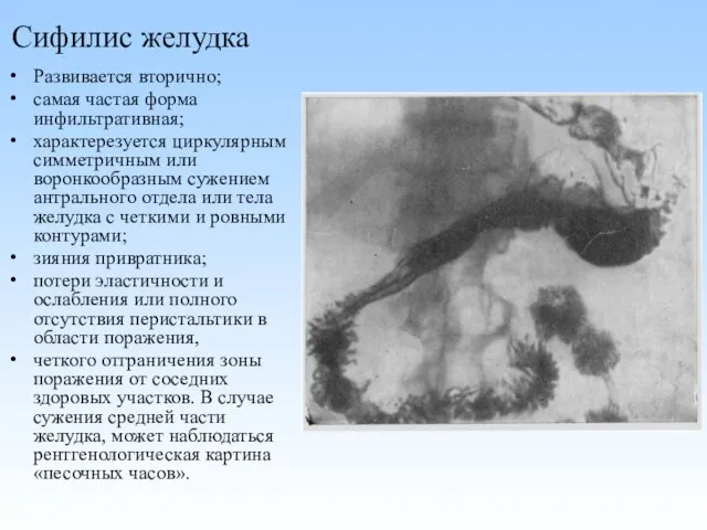 Сифилис желудка Развивается вторично; самая частая форма инфильтративная; характерезуется циркулярным симметричным