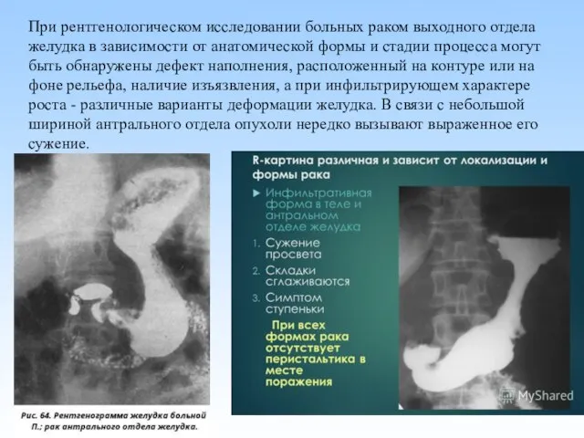 При рентгенологическом исследовании больных раком выходного отдела желудка в зависимости от