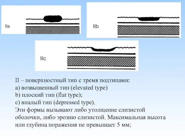 II – поверхностный тип с тремя подтипами: а) возвышенный тип (elevated