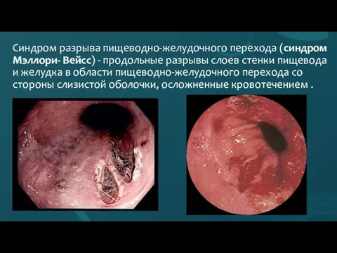 Синдром разрыва пищеводно-желудочного перехода (синдром Мэллори- Вейсс) - продольные разрывы слоев