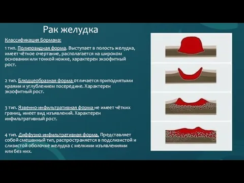 Рак желудка Классификация Бормана: 1 тип. Полиповидная форма. Выступает в полость