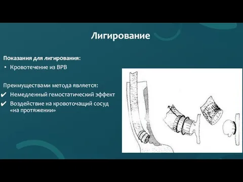 Лигирование Показания для лигирования: Кровотечение из ВРВ Преимуществами метода является: Немедленный