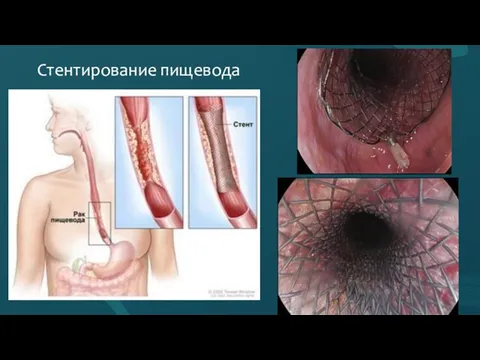 Стентирование пищевода