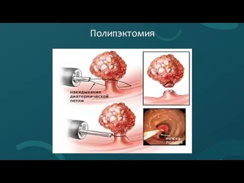 Полипэктомия