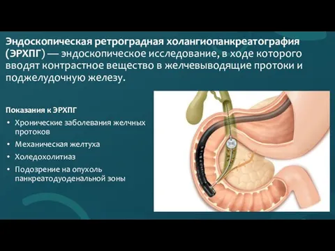 Эндоскопическая ретроградная холангиопанкреатография (ЭРХПГ) — эндоскопическое исследование, в ходе которого вводят