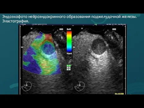 Эндоэхофото нейроэндокринного образования поджелудочной железы. Эластография.