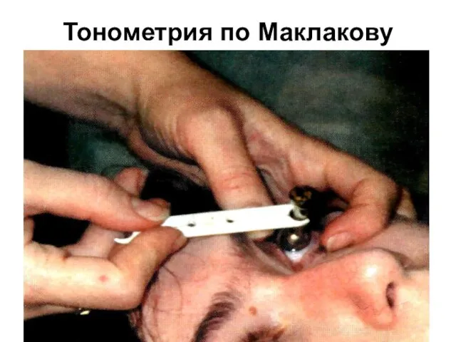 Тонометрия по Маклакову