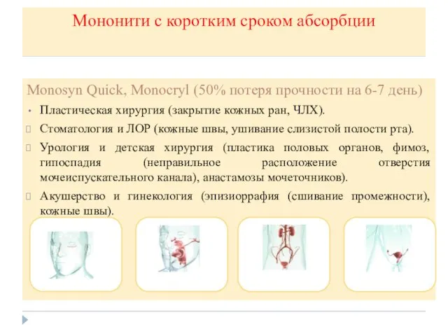 Мононити с коротким сроком абсорбции Monosyn Quick, Monocryl (50% потеря прочности