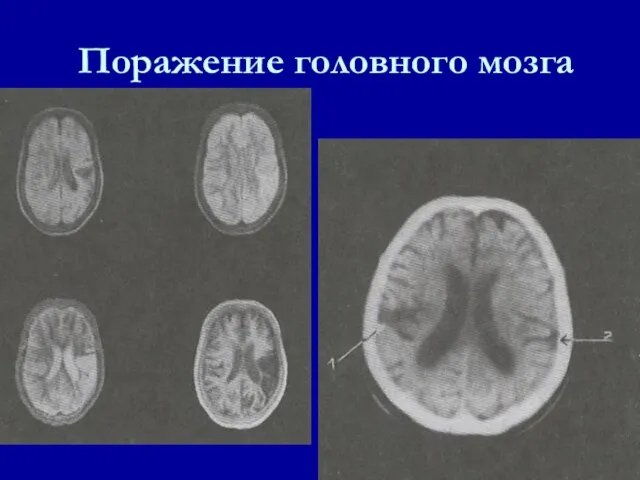 Поражение головного мозга