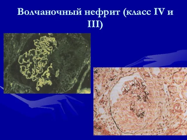 Волчаночный нефрит (класс IV и III)