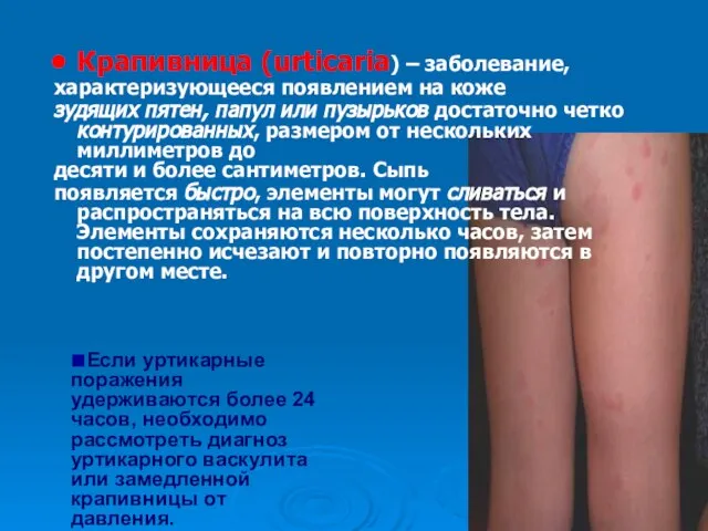 Крапивница (urticaria) – заболевание, характеризующееся появлением на коже зудящих пятен, папул