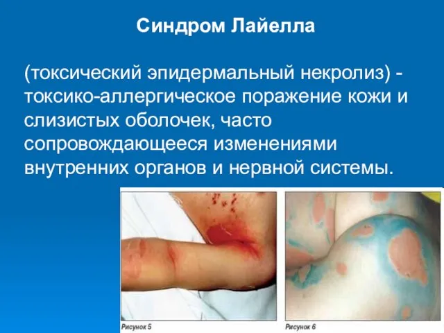 Синдром Лайелла (токсический эпидермальный некролиз) -токсико-аллергическое поражение кожи и слизистых оболочек,