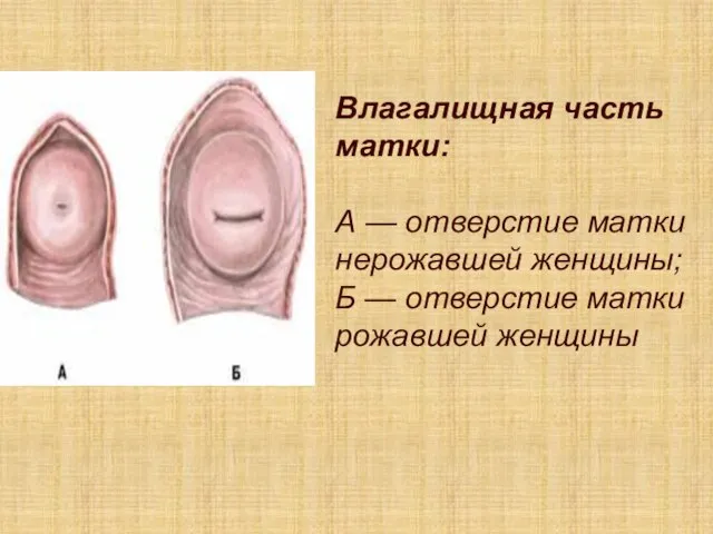 Влагалищная часть матки: А — отверстие матки нерожавшей женщины; Б — отверстие матки рожавшей женщины