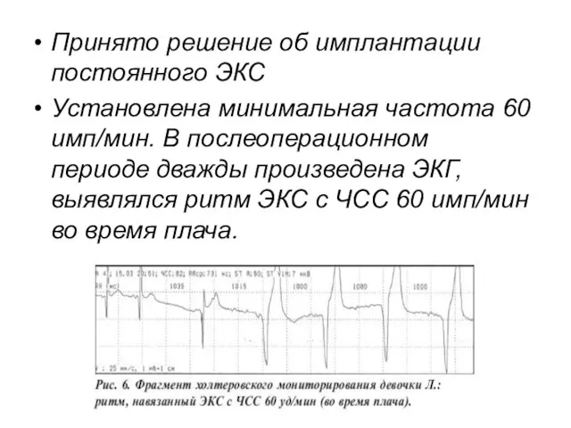 Принято решение об имплантации постоянного ЭКС Установлена минимальная частота 60 имп/мин.