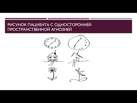 РИСУНОК ПАЦИЕНТА С ОДНОСТОРОННЕЙ ПРОСТРАНСТВЕННОЙ АГНОЗИЕЙ