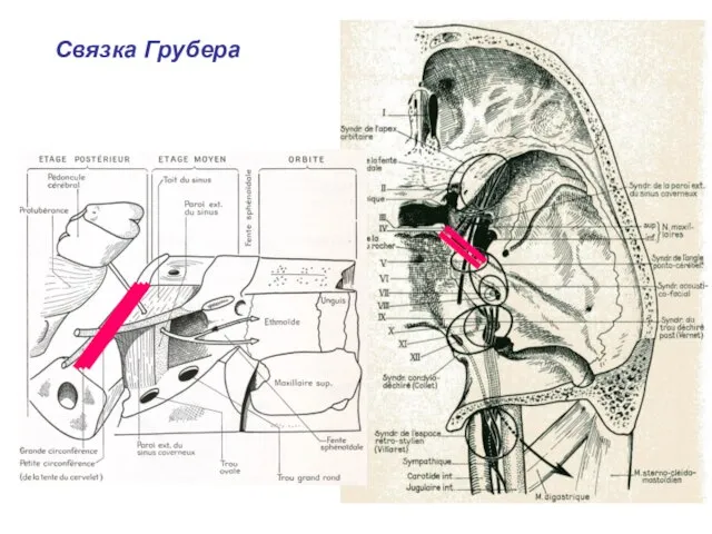 Связка Грубера