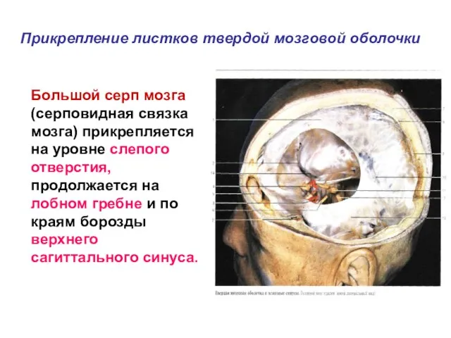 Большой серп мозга (серповидная связка мозга) прикрепляется на уровне слепого отверстия,