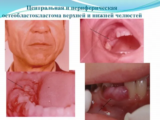 Центральная и периферическая остеобластокластома верхней и нижней челюстей