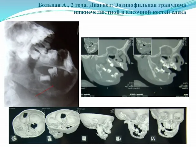 Больная А., 2 года. Диагноз: Эозинофильная гранулема нижнечелюстной и височной костей слева
