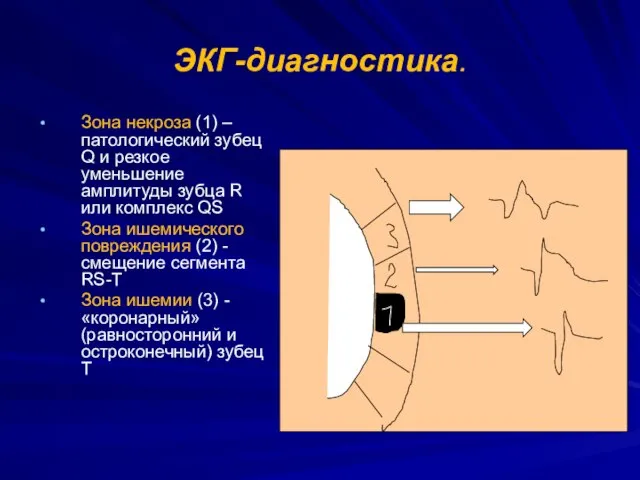 ЭКГ-диагностика. Зона некроза (1) –патологический зубец Q и резкое уменьшение амплитуды