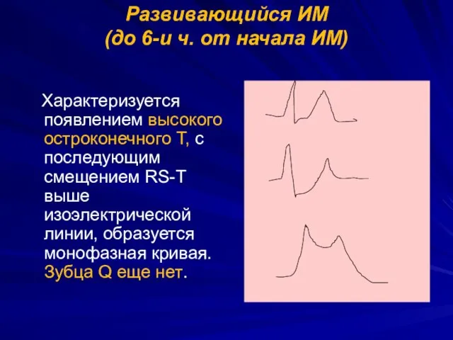 Развивающийся ИМ (до 6-и ч. от начала ИМ) Характеризуется появлением высокого