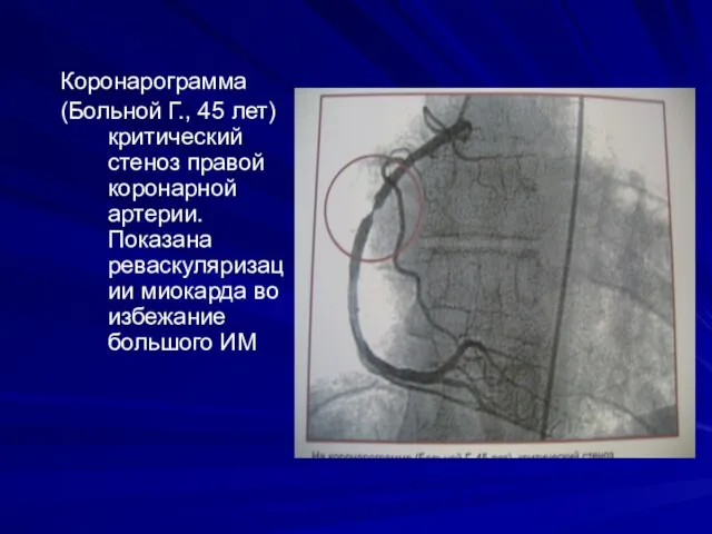 Коронарограмма (Больной Г., 45 лет) критический стеноз правой коронарной артерии. Показана