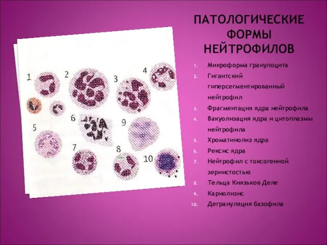 ПАТОЛОГИЧЕСКИЕ ФОРМЫ НЕЙТРОФИЛОВ Микроформа гранулоцита Гигантский гиперсегментированный нейтрофил Фрагментация ядра нейтрофила