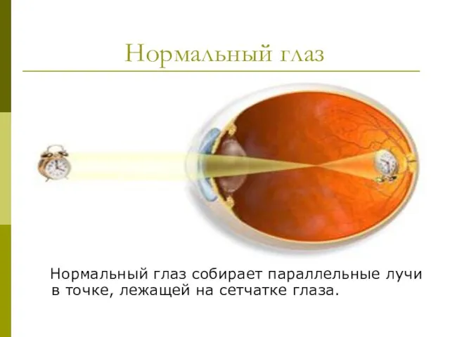 Нормальный глаз Нормальный глаз собирает параллельные лучи в точке, лежащей на сетчатке глаза.