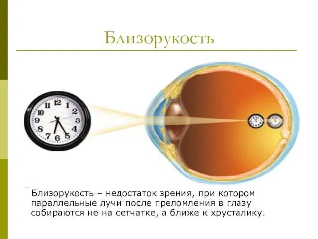 Близорукость Близорукость – недостаток зрения, при котором параллельные лучи после преломления