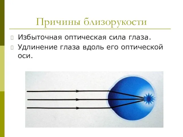 Причины близорукости Избыточная оптическая сила глаза. Удлинение глаза вдоль его оптической оси.