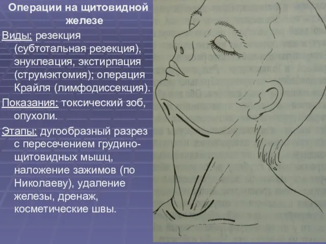 Операции на щитовидной железе Виды: резекция (субтотальная резекция), энуклеация, экстирпация (струмэктомия);