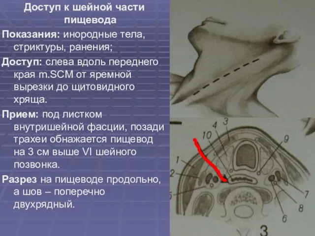 Доступ к шейной части пищевода Показания: инородные тела, стриктуры, ранения; Доступ: