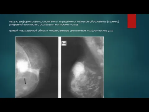 железа деформирована, сосок втянут; определяется овальное образование (стрелка) умеренной плотности с