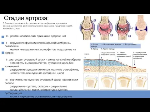 Стадии артроза: 1. Кость 3. Истончение хряща 5. Разрушение хряща 2.