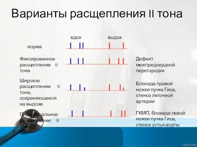 Варианты расщепления II тона вдох выдох Фиксированное расщепление II тона Широкое